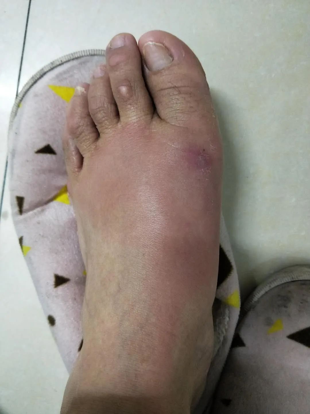 而在搔抓导致进一步感染后,脚气就有可能会诱发淋巴管炎,下肢丹毒甚至