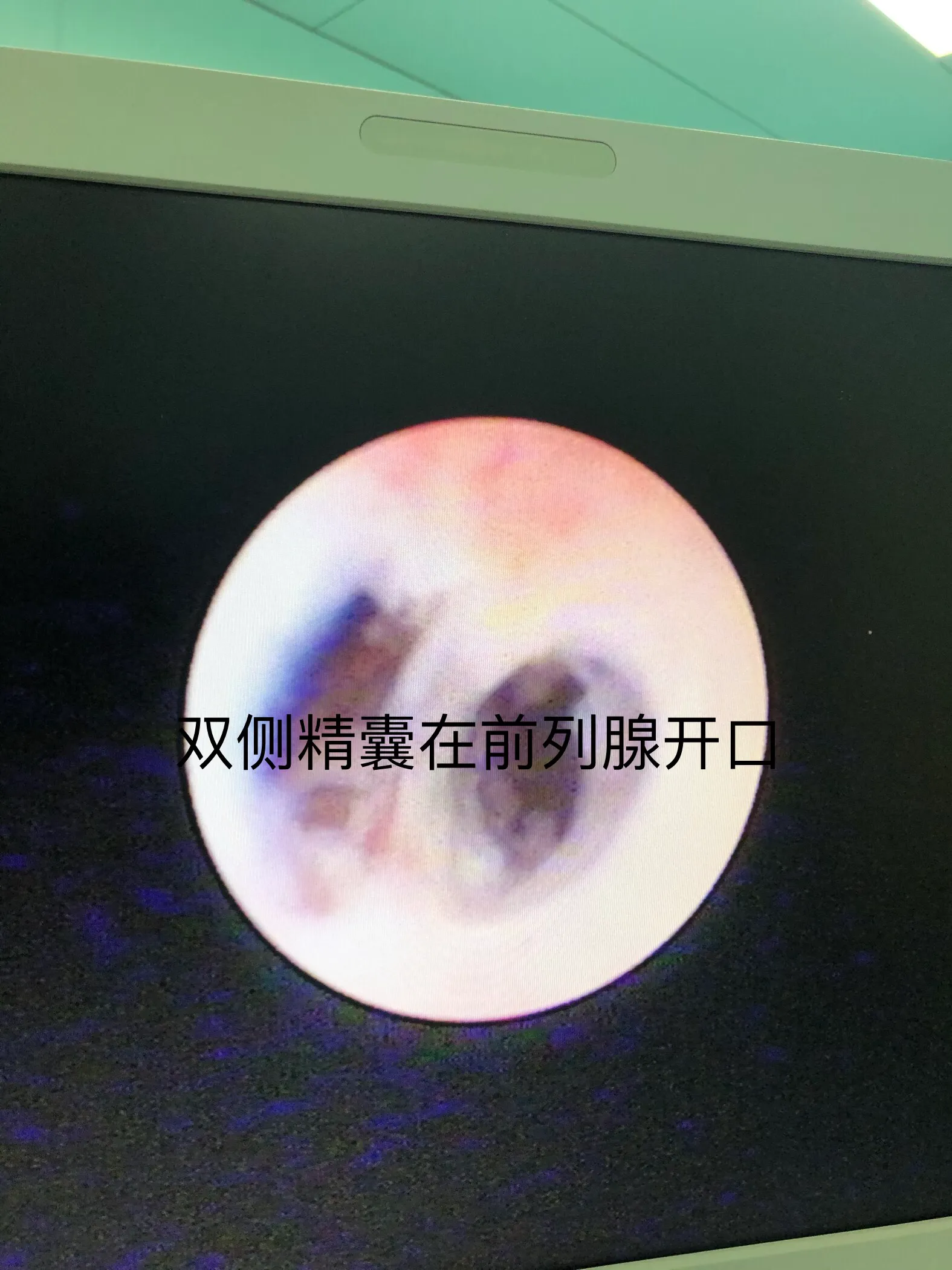 男科手术探秘6:精囊炎血精、精囊结石和精囊镜手术、钬激光碎石
