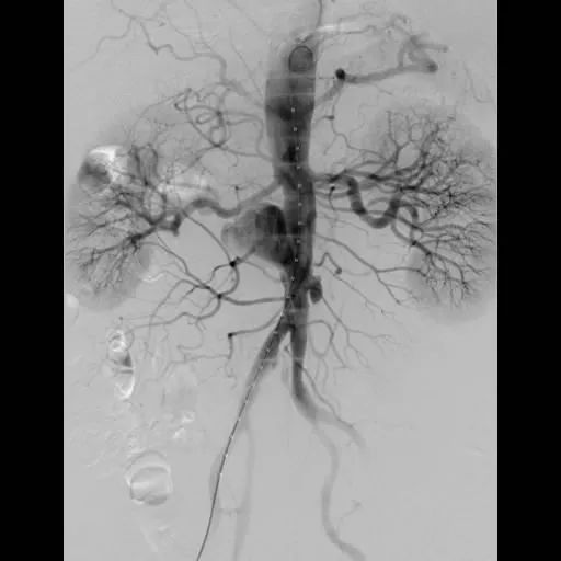 8小时完成高危病症手术，让患者一周出院，中国医大一院又实现新的突破！