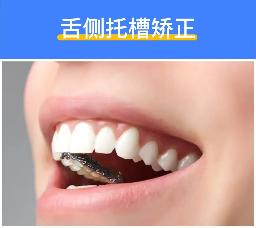 深度揭秘:牙齿矫正到底需要多少钱?