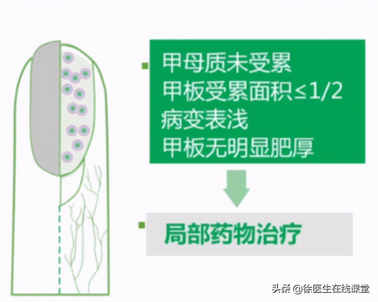 指甲油清洗小窍门及灰指甲治疗方法