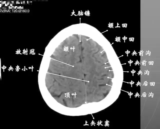 简明又详细的头部CT读片详解，收藏