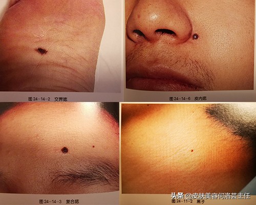 点痣后增生凸起图片(色素痣要怎么处理) - 赤虎壹号