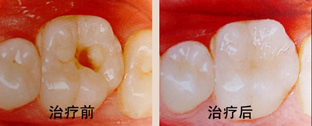 不去医院、不花钱，在家就能治牙病？掌握3点，看牙能省一半钱