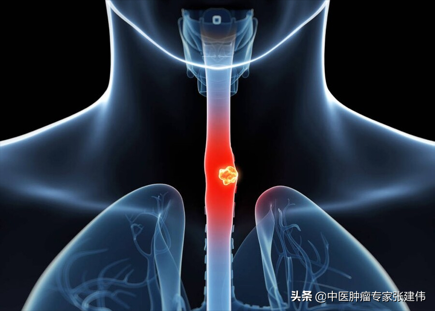 出现吞咽困难，是咽炎还是食管癌？怎么区分？关键在于这一点