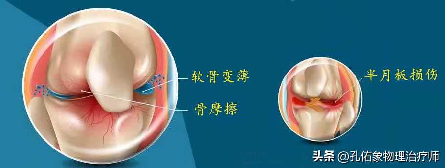 膝关节疼痛是怎么回事？常见的6个部位、8大病因，不可忽视