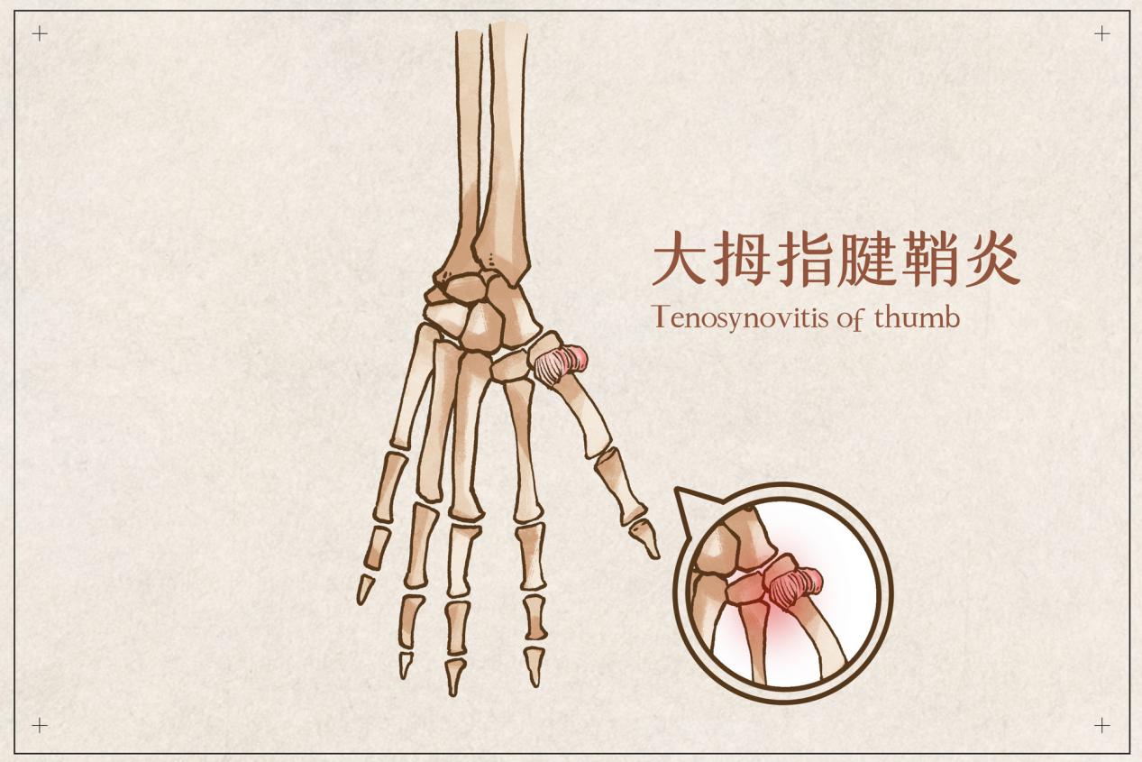 大腱鞘炎治疗方法及手指腱鞘炎处理指南
