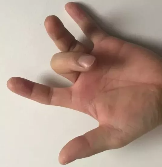 手中指关节痛怎么回事(医生) - seo葵花宝典