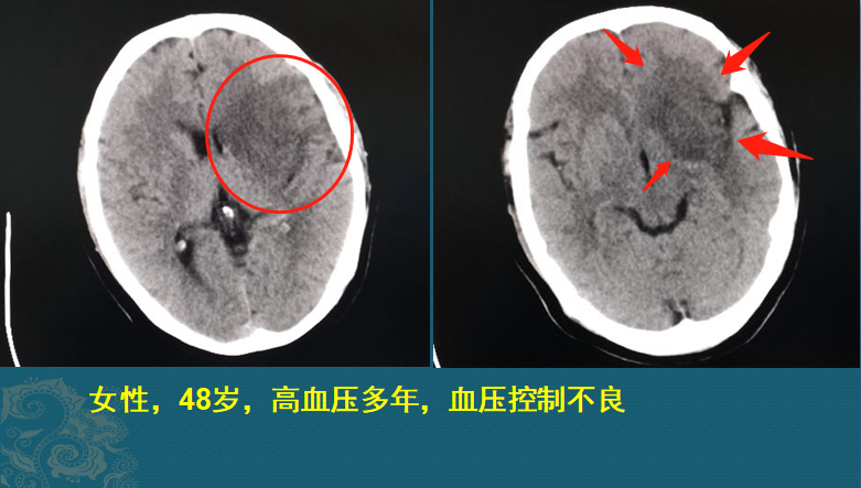 长年吃降压药副作用大？这2位病人后悔没吃药，没有后悔药了