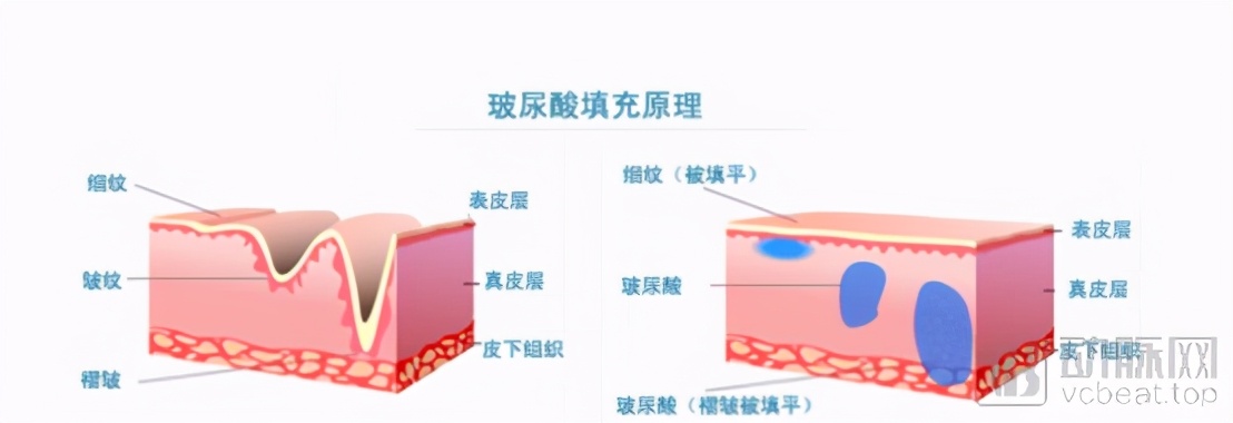 韩国德玛玻尿酸(玻尿酸：医美中的茅台，一门百亿级的颜值生意)