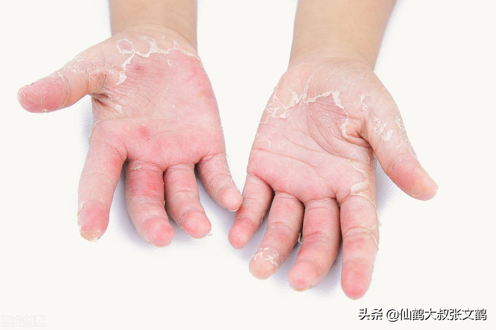 比如皮肤浅部真菌感染所致一种癣菌疹,但许多患者没有真菌感染也会