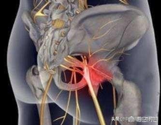 中医博士说：坐骨神经痛的主要原因，您知道吗？