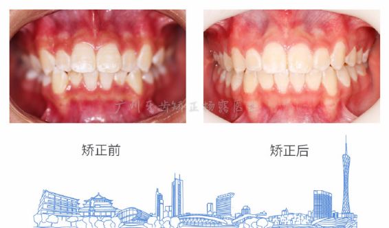 广州牙齿矫正杨露隐适美隐形矫正戴牙套全案例