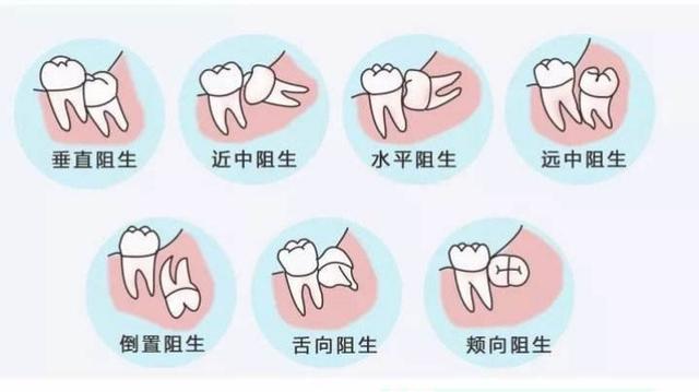 为何别人拔牙只需要几百块，我却要花上千块？其实都是牙长的太歪