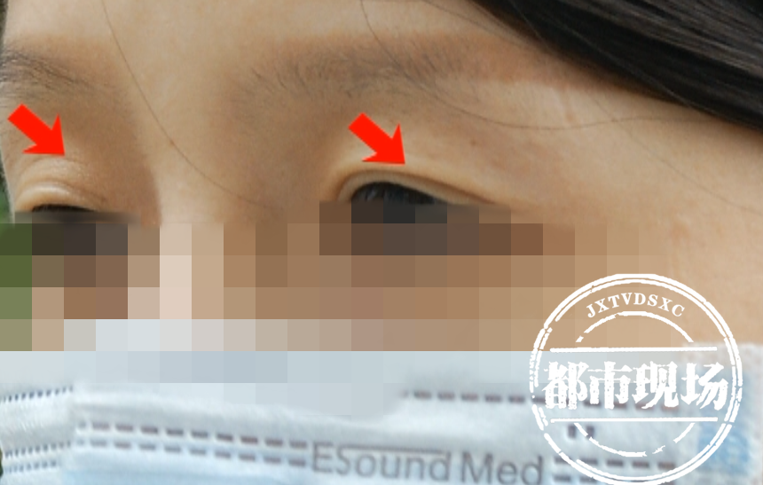 女子在南昌“韩雅医疗美容”做眼综合手术，结果失望了