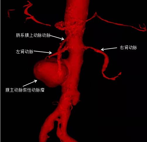 8小时完成高危病症手术，让患者一周出院，中国医大一院又实现新的突破！