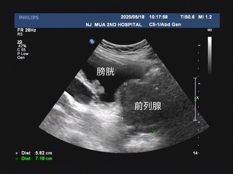 前列腺增生都有哪些危险因素？读者可以从哪些方面注意？