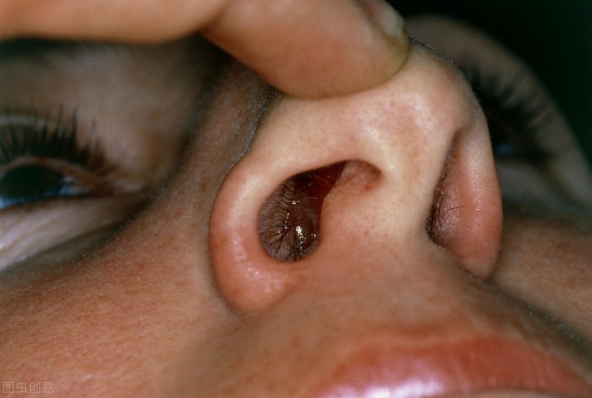 鼻窦粘膜囊肿图片