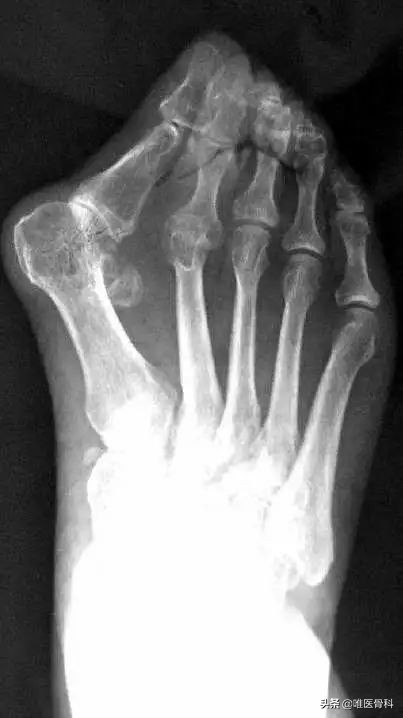 为什么nba脚趾变形（詹姆斯的拇外翻-光芒背后有多少疼痛你永远不懂）