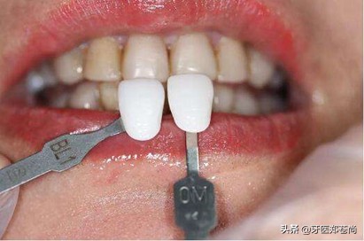 牙齿贴面能维持多长时间？