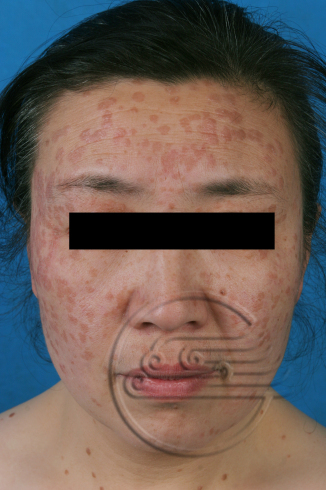 儿童传染性软疣怎么处理比较安全