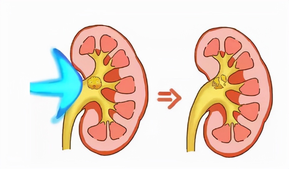 打过一次肾结石，还能再打吗？今天就讲讲关于碎石的那点事
