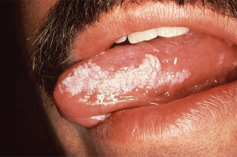 舌癌和上火的区别图片