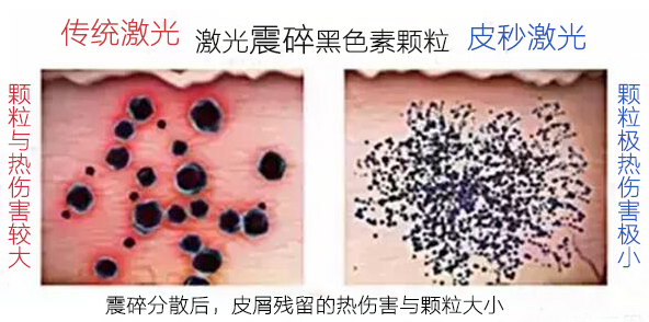 皮秒激光祛斑会反黑、皮肤变薄吗？内行人告诉你真相是这样