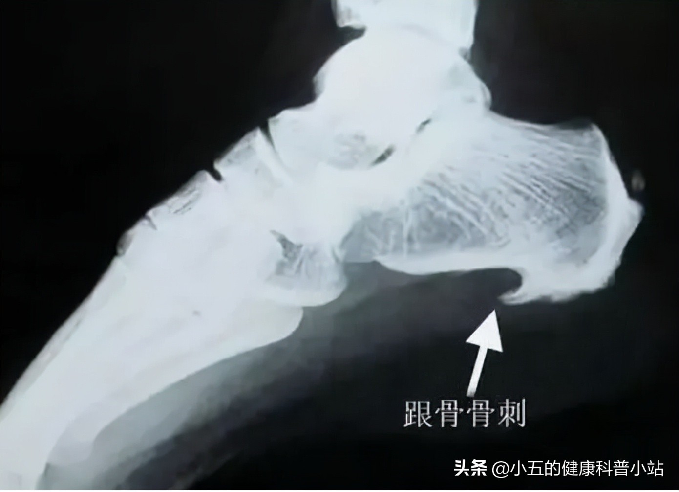 突发足跟痛要考虑这5种疾病，日常保健和治疗要注意6点