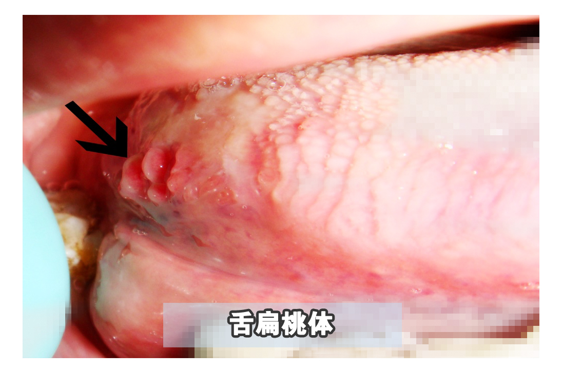 嘴里长了可怕的“肉揪”，真的不是口腔癌吗？
