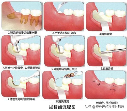 智齿拔了有个洞很臭(拔智齿后嘴里恶臭是什么情况？)