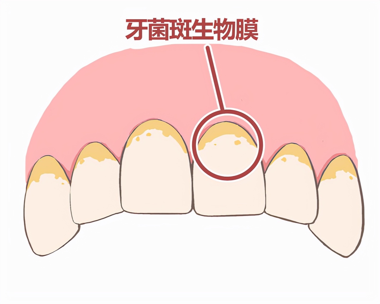 牙龈增生的原因图片