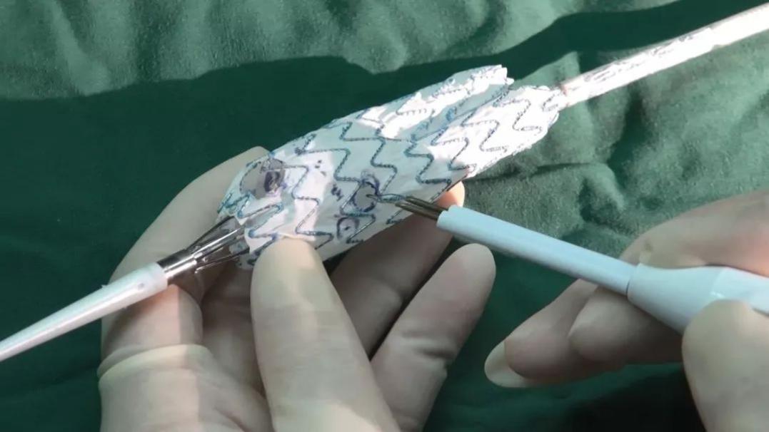 8小时完成高危病症手术，让患者一周出院，中国医大一院又实现新的突破！