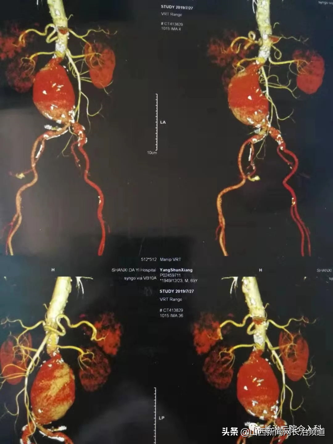 山西甲下血管球瘤哪里做的好(长治二院介入科顺利完成首例巨大腹主动脉瘤腔内隔绝术)