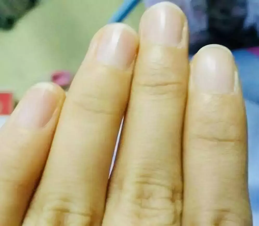 指甲长竖纹、白斑、黑线是疾病征兆？这些实情，现在知道还不晚