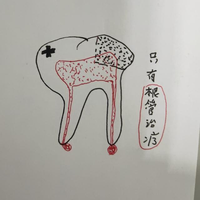 口腔医生耐心画图为你解答|牙齿龋病的正规治疗方式