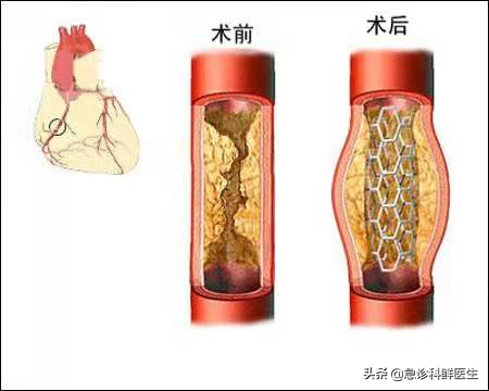 心脏支架手术，到底是治病救人，还是缺德害人？医生告诉你真相