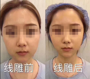 常见的面部抗衰项目有六种，能去皱美肤，恢复你的年轻貌美