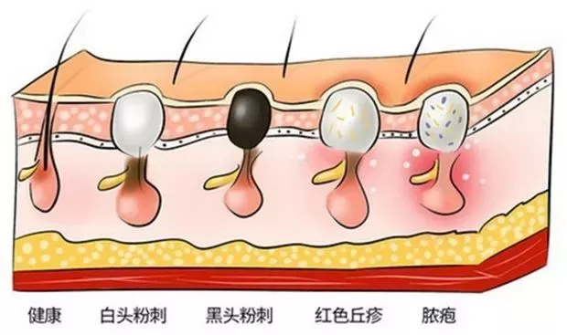 男生脸上毛孔大有黑头怎么回事 男生脸上有很多黑头如何处理