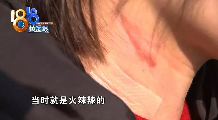 美容店里拔火罐，酒精洒出身上多处被烧伤，回应：员工个人行为