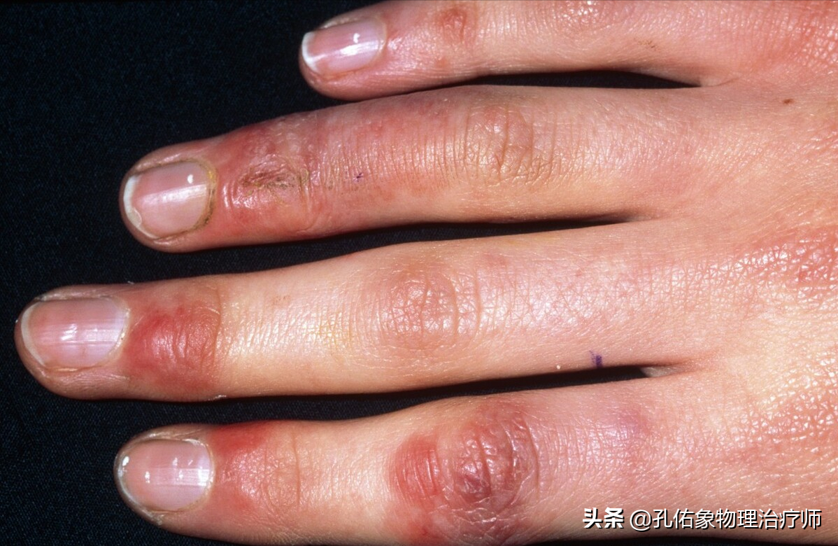 手指肿胀要警惕四种病,手指头肿胀怎么办