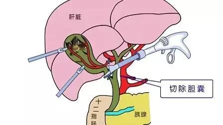 胆囊疾病什么情况需要手术？医生告诉你：切除只是其中一种方式