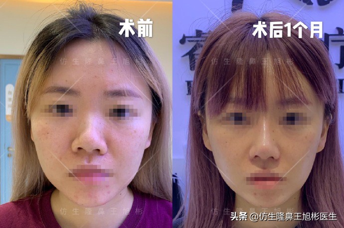 如何定义短鼻，短鼻延长后的改变有多大？