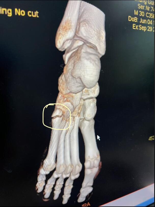 张国伟为什么被退队2021(张国伟自曝训练过度致跖骨骨折,争取明年6月