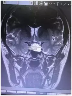 既未婚，又没有男盆友！20岁女大学生分泌乳汁？！