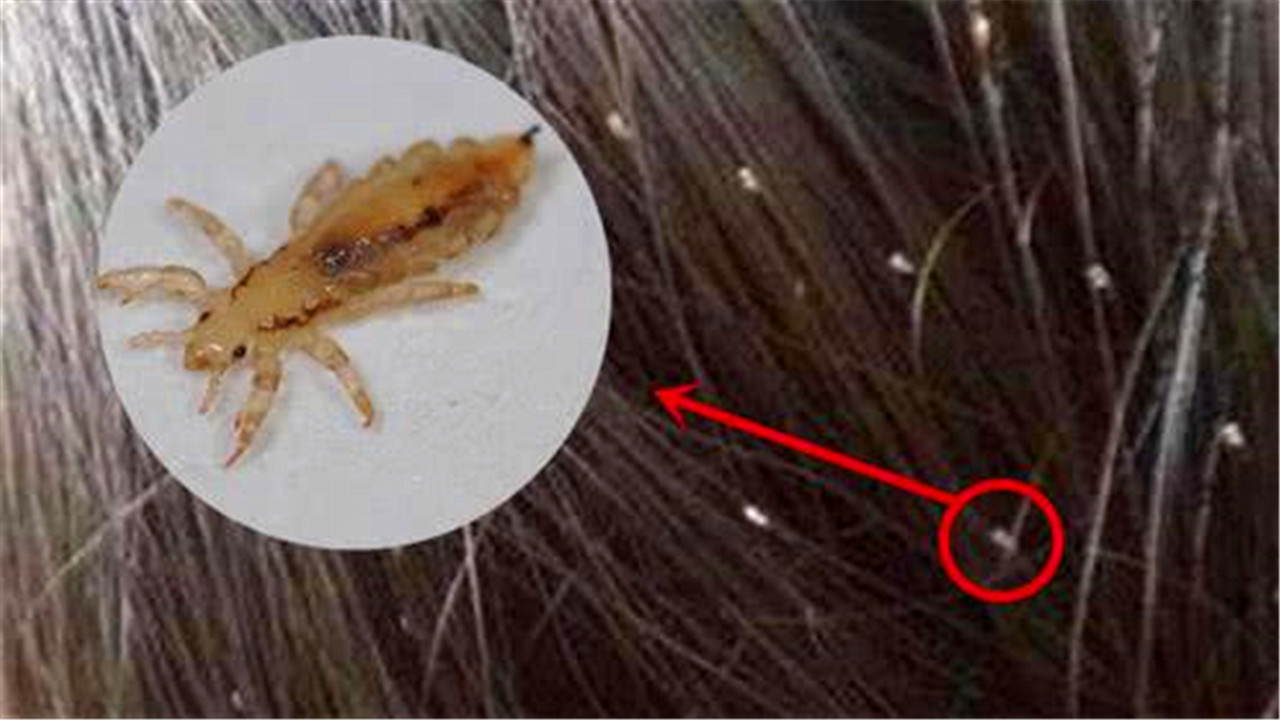 头发虱子图片(同人类共进化) - 赤虎壹号