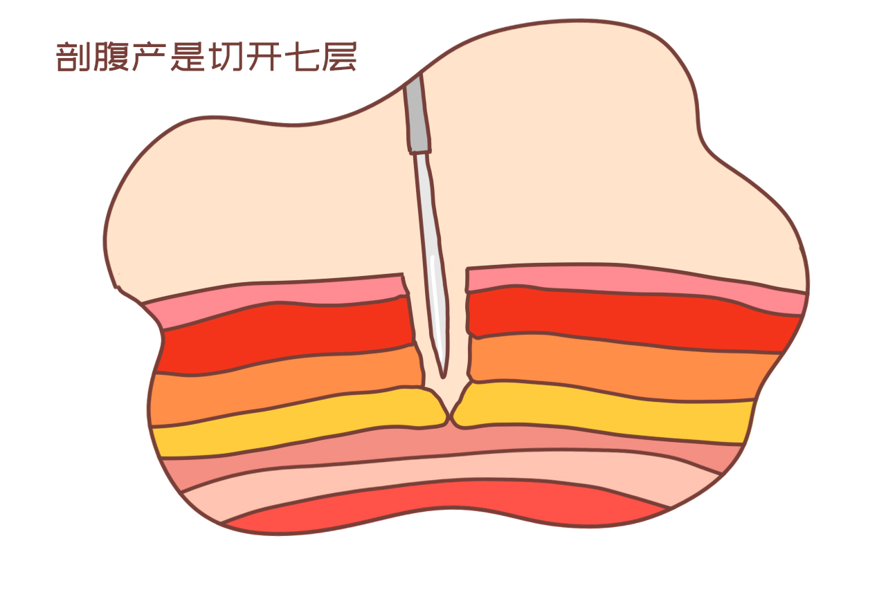 生孩子时，顺不下来转剖腹要收两份钱？过来人一番话真相了