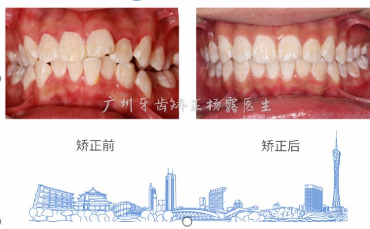 广州牙齿矫正杨露隐适美隐形矫正戴牙套全案例