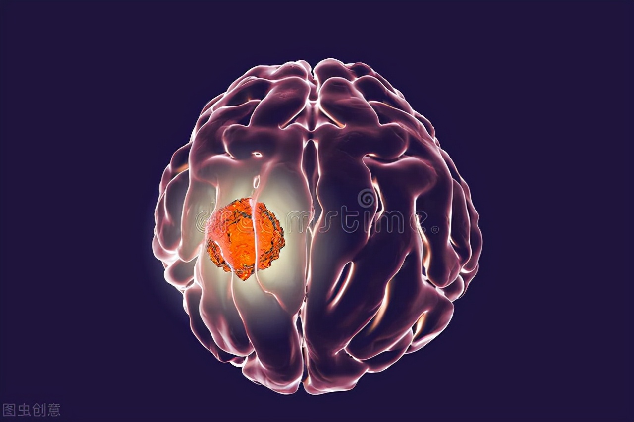 男子长期头晕误当颈椎病，一查竟是脑瘤！医生总结脑瘤的9大征兆