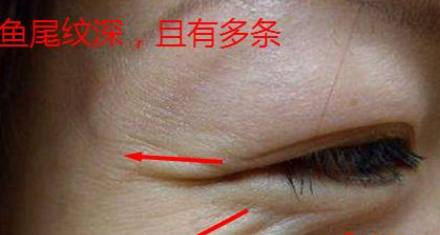 眼睛的轮匝肌经年累月下,因为变得肥厚以及收缩力增强,笑的时候很容易